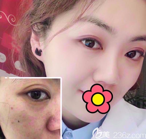 呼市大韩整形医院注射前后效果对比照片