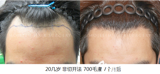 韩国毛杰琳男性非切开法种植700毛囊术前与术后7个月真实效果对比图