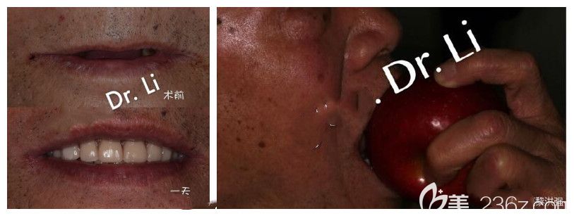 中山好民生口腔黎洪强牙齿种植案例 中山好民生口腔黎洪强牙齿种植案例