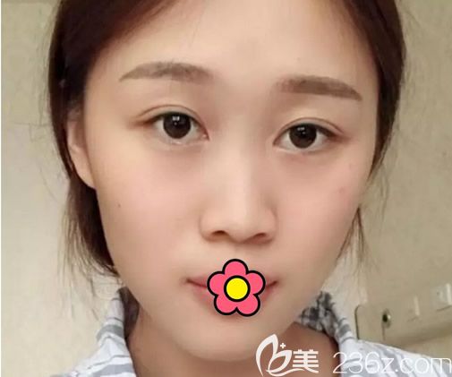 呼和浩特大韩整形找金成植院长做鼻综合隆鼻前 呼和浩特大韩整形找金成植院长做鼻综合隆鼻前