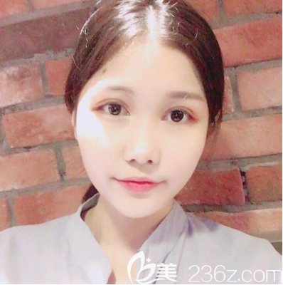 朱晓梅医生眼综合术后三天效果图 朱晓梅医生眼综合术后三天效果图