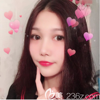 东莞维多利亚朱晓梅医生双眼皮手术案例 东莞维多利亚朱晓梅医生双眼皮手术案例