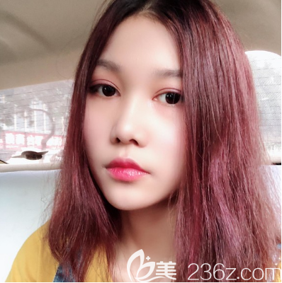 看闺蜜在东莞维多利亚做的双眼皮效果不错,我也去找朱晓梅医生做了眼综合