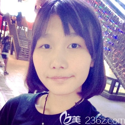 在东莞维多利亚做双眼皮术前照片 在东莞维多利亚做双眼皮术前照片