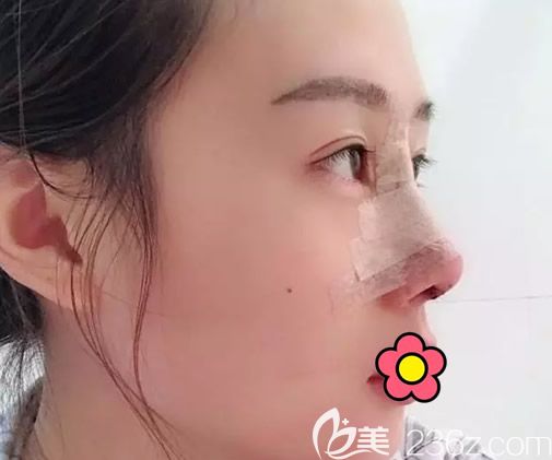 大韩整形金成植博士假体隆鼻+耳软骨垫鼻尖第四天效果 大韩整形金成植博士假体隆鼻+耳软骨垫鼻尖第四天效果