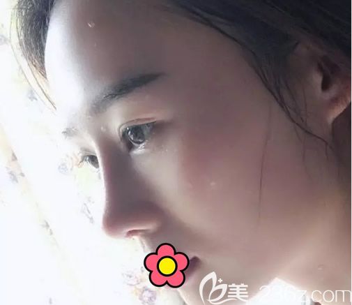 硅胶假体隆鼻第20天恢复图 硅胶假体隆鼻第20天恢复图