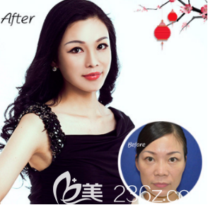 烟台鹏爱医院线雕提升案例 烟台鹏爱医院线雕提升案例