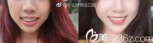 中山好民生口腔正畸怎么样？张华医生精品牙齿矫正案例公布