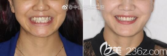 张华牙齿不齐、虎牙矫正案例