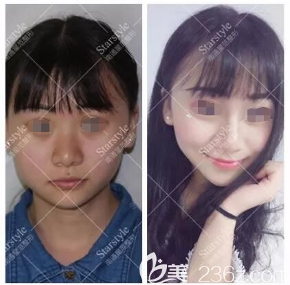 肌肉咬肌大脸在南通星范一剂瘦脸针就搞定了不止一个案例都说效果好哦