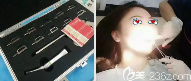 中山好民生口腔牙齿矫正片切过程