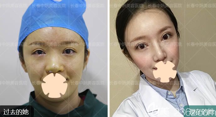 长春中妍整形赵胜友鼻综合案例效果对比图 长春中妍整形赵胜友鼻综合案例效果对比图