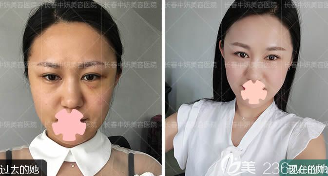 长春中妍整形美容全面部线雕提升效果对比 长春中妍整形美容全面部线雕提升效果对比