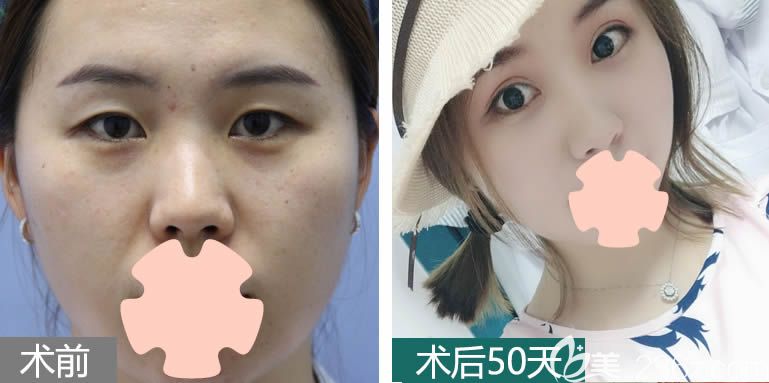 长春中妍整形美容特色重睑术案例效果 长春中妍整形美容特色重睑术案例效果