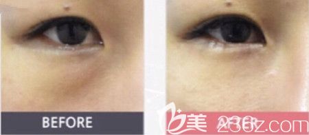 韩国DIVA眼底脂肪重置手术案例