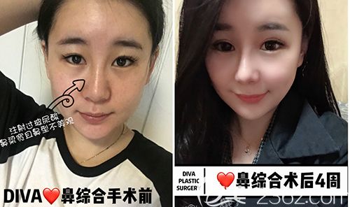 韩国DIVA鼻综合手术案例案例