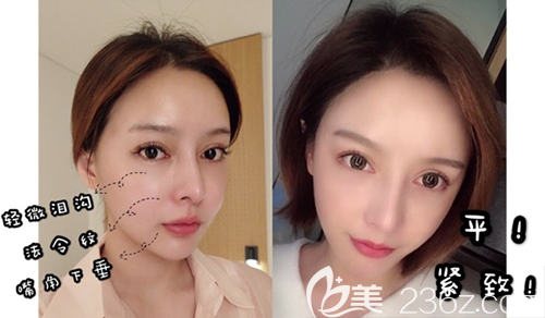 韩国DIVA面部案例