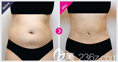 韩国perfectline整形外科腰腹吸脂