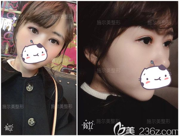 年幼无知做的埋线双眼皮压迫导致提肌无力还出现抬头纹 面诊江苏施尔美孙欣做修复后还给出价格贵在哪