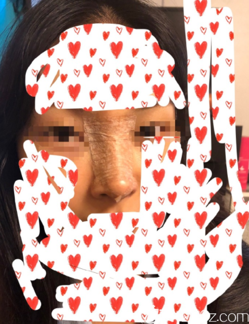 韩国NANO 赵重衍隆鼻真人案例