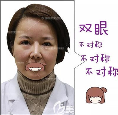 双眼皮修复手术前的照片 双眼皮修复手术前的照片