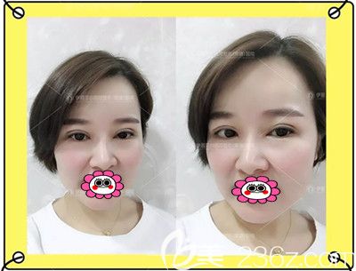 双眼皮修复术后3个月变化图 双眼皮修复术后3个月变化图