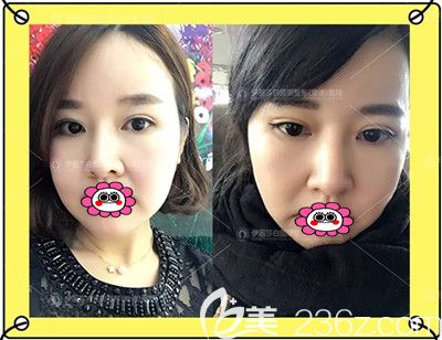 全切双眼皮修复术后1个月效果图 全切双眼皮修复术后1个月效果图