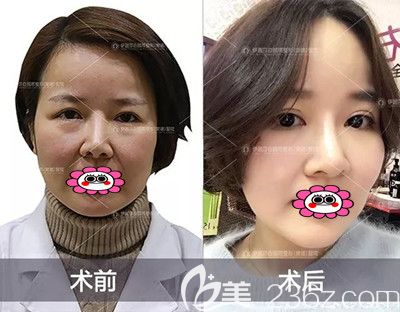 半年前我趁着活动在常德伊丽莎白做了全切双眼皮修复，效果怎么样看图说话