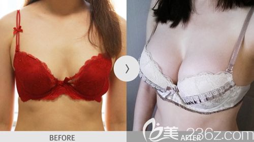 韩国麦恩脂肪隆胸案例