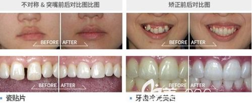 韩国首尔椰美牙科医院美牙案例 韩国首尔椰美牙科医院美牙案例