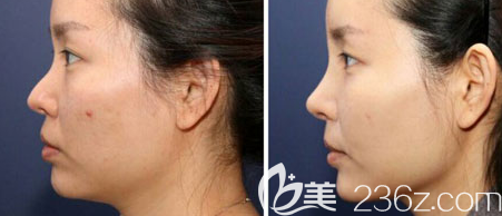 西安鼻修复案例