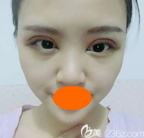 眼睛一大一小的我找赣州华美牛先翠做全切双眼皮术后第7天效果