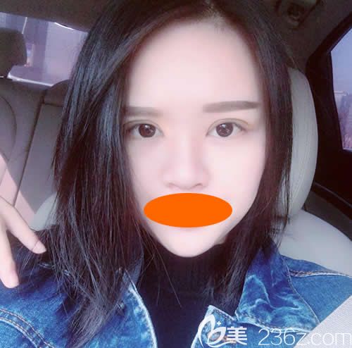 眼睛一大一小的我找赣州华美牛先翠做全切双眼皮术后第20天效果