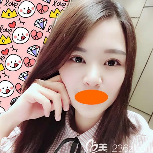 眼睛一大一小的我找赣州华美牛先翠做全切双眼皮术后第32天效果