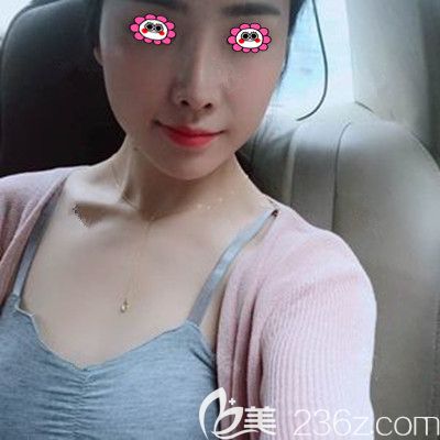 假体丰胸前的样子 假体丰胸前的样子