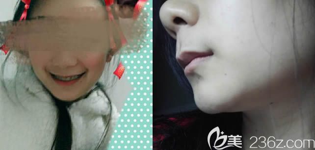 深圳乐莎莎口腔正畸科案例记实：27岁暴牙女的脱变