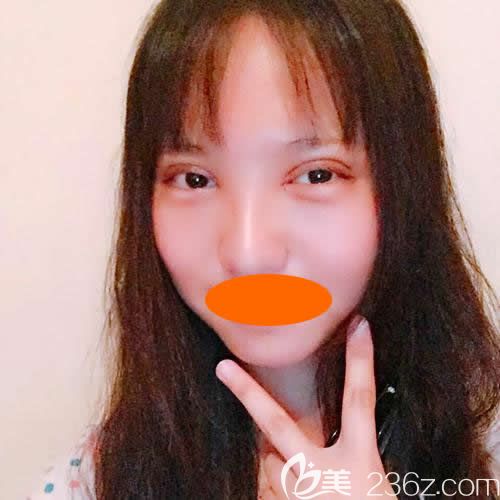 上饶尚美整形刘育凤给我做新月型双眼皮术后第3天效果