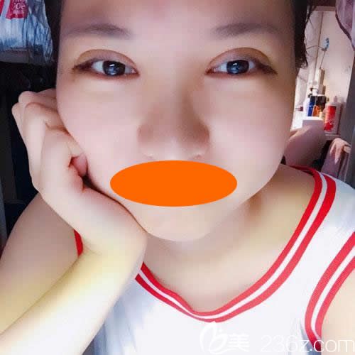 上饶尚美整形刘育凤给我做新月型双眼皮术后第7天效果图