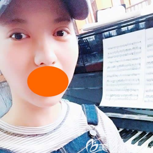 找上饶尚美刘育凤做新月型双眼皮术后第14天效果