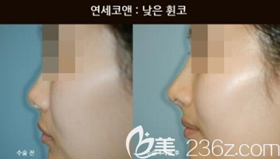 韩国Yonsei C＆ENT隆鼻手术案例