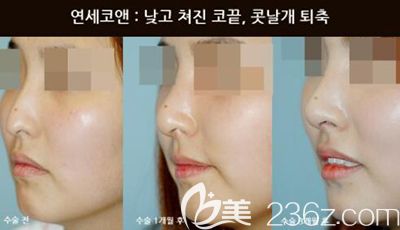 韩国Yonsei C＆ENT鼻部矫正前后对比照片