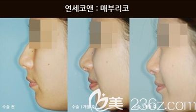 韩国Yonsei C＆ENT鼻部整形照片
