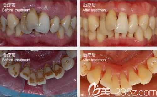 厦门登特口腔<!--<i data=20240703-sp></i>-->颖医生牙周病治疗前后对比图 厦门登特口腔<!--<i data=20240703-sp></i>-->颖医生牙周病治疗前后对比图