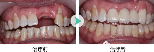 青岛维乐口腔张奎医生即刻种植牙案例 青岛维乐口腔张奎医生即刻种植牙案例