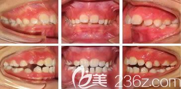 厦门登特口腔陈欢喜医生儿童早期牙齿矫正效果图 厦门登特口腔陈欢喜医生儿童早期牙齿矫正效果图