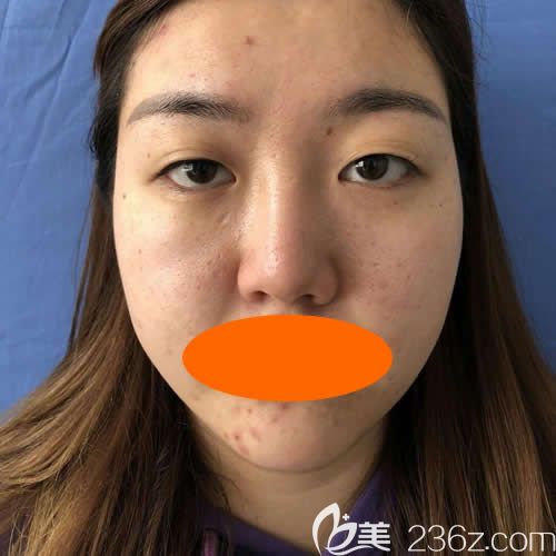 景德镇圣嘉丽院长刘志强做眼综合+鼻综合术前照片 景德镇圣嘉丽院长刘志强做眼综合+鼻综合术前照片