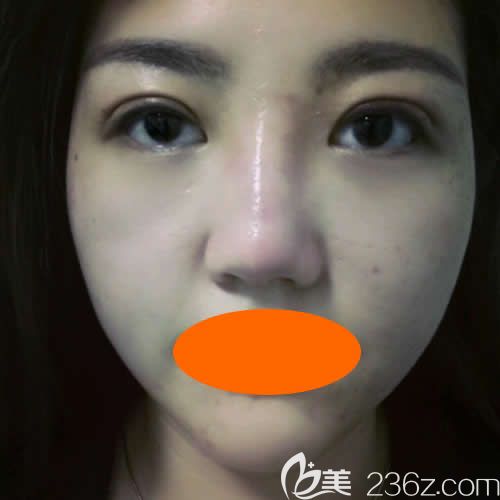 找景德镇圣嘉丽院长刘志强做眼综合+鼻综合术后第7天效果图 找景德镇圣嘉丽院长刘志强做眼综合+鼻综合术后第7天效果图