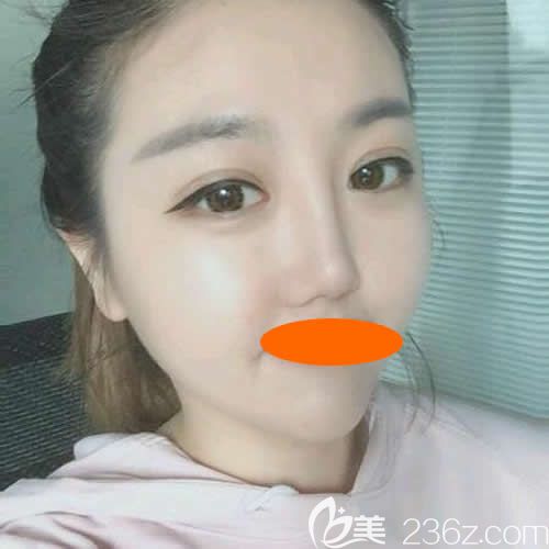 找景德镇圣嘉丽院长刘志强做眼综合+鼻综合术后第20天效果 找景德镇圣嘉丽院长刘志强做眼综合+鼻综合术后第20天效果