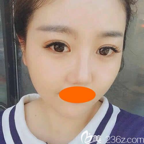 找景德镇圣嘉丽院长刘志强做眼综合+鼻综合术后第36天效果 找景德镇圣嘉丽院长刘志强做眼综合+鼻综合术后第36天效果