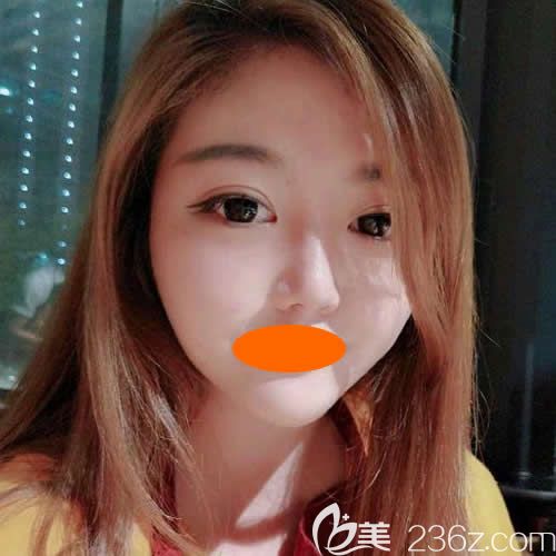 找景德镇圣嘉丽院长刘志强做眼综合+鼻综合术后第48天效果 找景德镇圣嘉丽院长刘志强做眼综合+鼻综合术后第48天效果